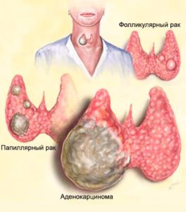 рак щитовидки