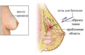 биопсия груди