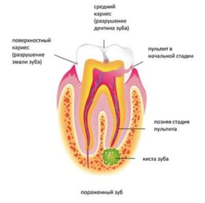 схема кисты зуба