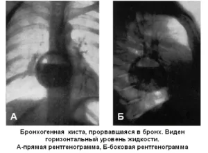 Бронхогенная киста