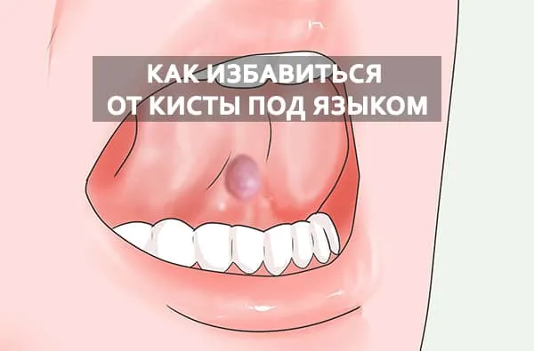 образование под языком