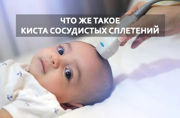 сосудистые сплетения