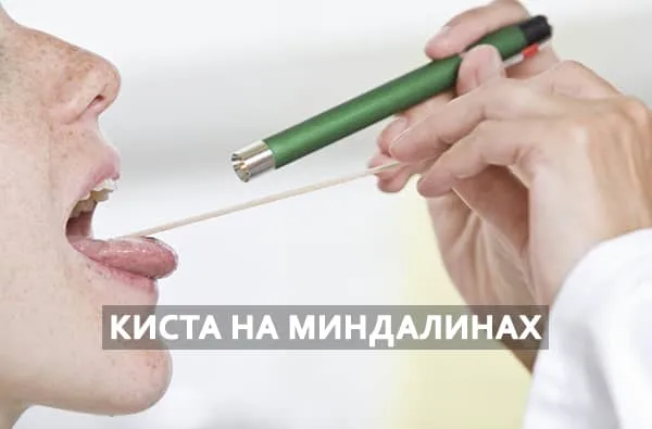 киста миндалины