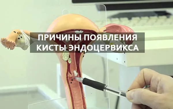 причины появления опухоли шейки матки