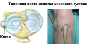 Изображение - Киста коленного сустава причины kista-meniska-kolennogo-sustava-300x144