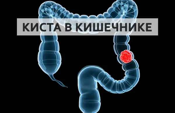 киста в кишечнике