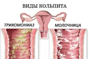 кольпит молочница