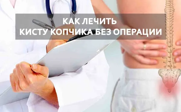 как лечить копчик без операции