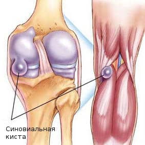 Изображение - Киста коленного сустава причины sinovialnaya-kista