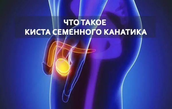 киста придатка