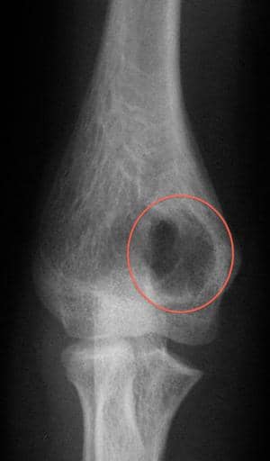Рак кости ноги. Костная киста плечевой кости рентген. Остеосаркома коленного сустава рентген. Остеосаркома плечевой кости. Саркома плечевой кости рентген.