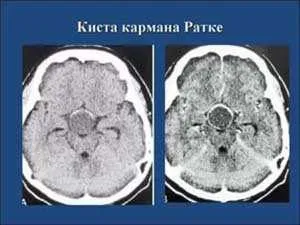 киста ратке на снимке