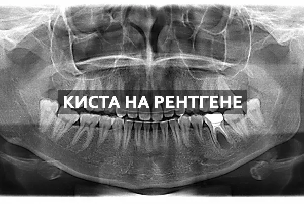 снимок зуба