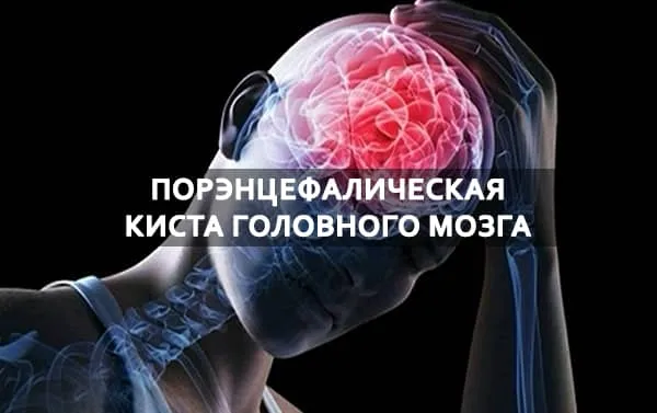 порэнцефалическая