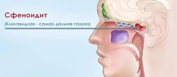 сфеноидит