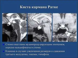 киста ратке снимок