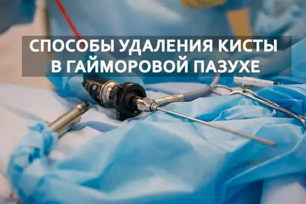 удаление образований в гайморовой