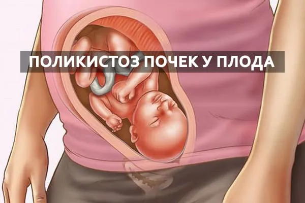 киста у плода