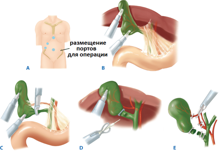 Холецистит и лапароскопическая холецистэктомия. ЖКБ лапароскопическая холецистэктомия. Холецистэктомия точки лапароскопии. Лапароскопическая холецистэктомия этапы.