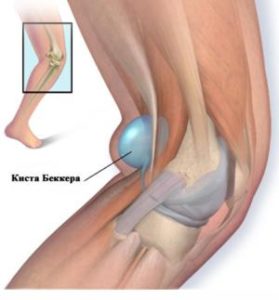 Изображение - Диета при кисте бейкера коленного сустава kista-bekkera-279x300