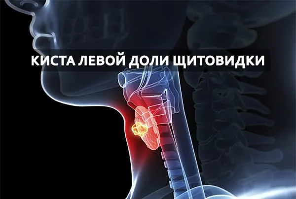киста левой доли щитовидки