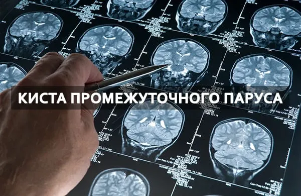опухоль промежуточного паруса
