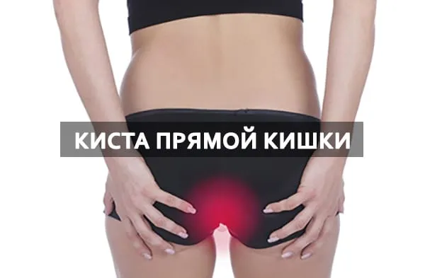 полип прямой кишки