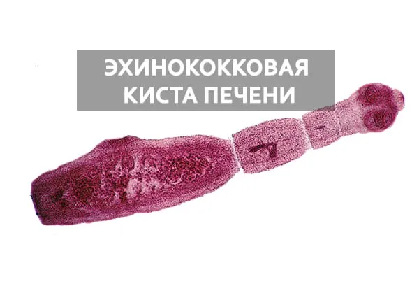 эхинококк в печени