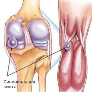 Лечение ганглиевая киста коленного сустава thumbnail