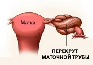 перекрут маточной трубы