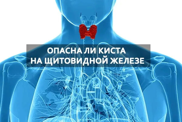опасна ли на щиовидке киста