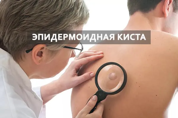 эпидермоид