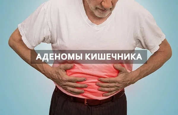 аденомы кишечника