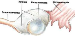 Киста яичника у плода во время беременности