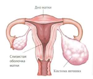 схема яичника с кистомой