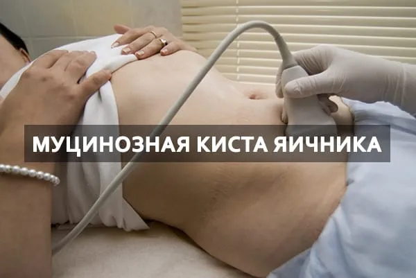 муцинозная киста