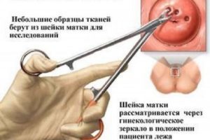 Биопсия шейки матки при кисте яичника thumbnail