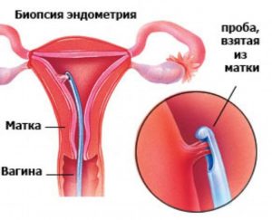 Биопсия шейки матки при кисте яичника