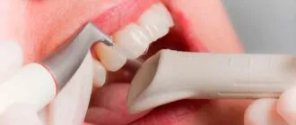 чистка зубов методом Air Flow